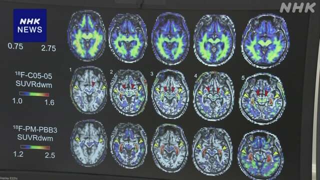 パーキンソン病 異常なたんぱく質 患者の脳内で撮影成功と発表 | NHK 