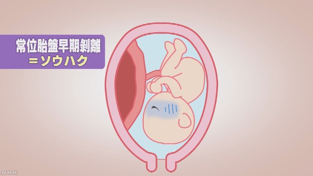 位 胎盤 早期 剥離 常