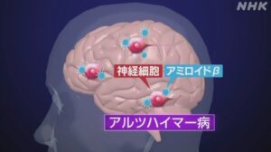 アルツハイマー病の新治療薬 アメリカで承認 日本では？